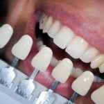 BLANQUEAMIENTO DENTAL