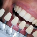 BLANQUEAMIENTO DENTAL