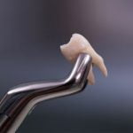 EXTRACCIONES DENTALES