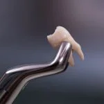 EXTRACCIONES DENTALES