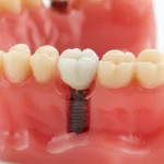 IMPLANTES DENTALES