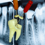 TRATAMIENTOS CONDUCTOS - ENDODONCIAS