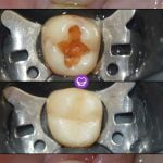 RESTAURACIONES - ARREGLOS DENTALES