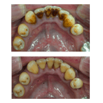 LIMPIEZAS DENTALES