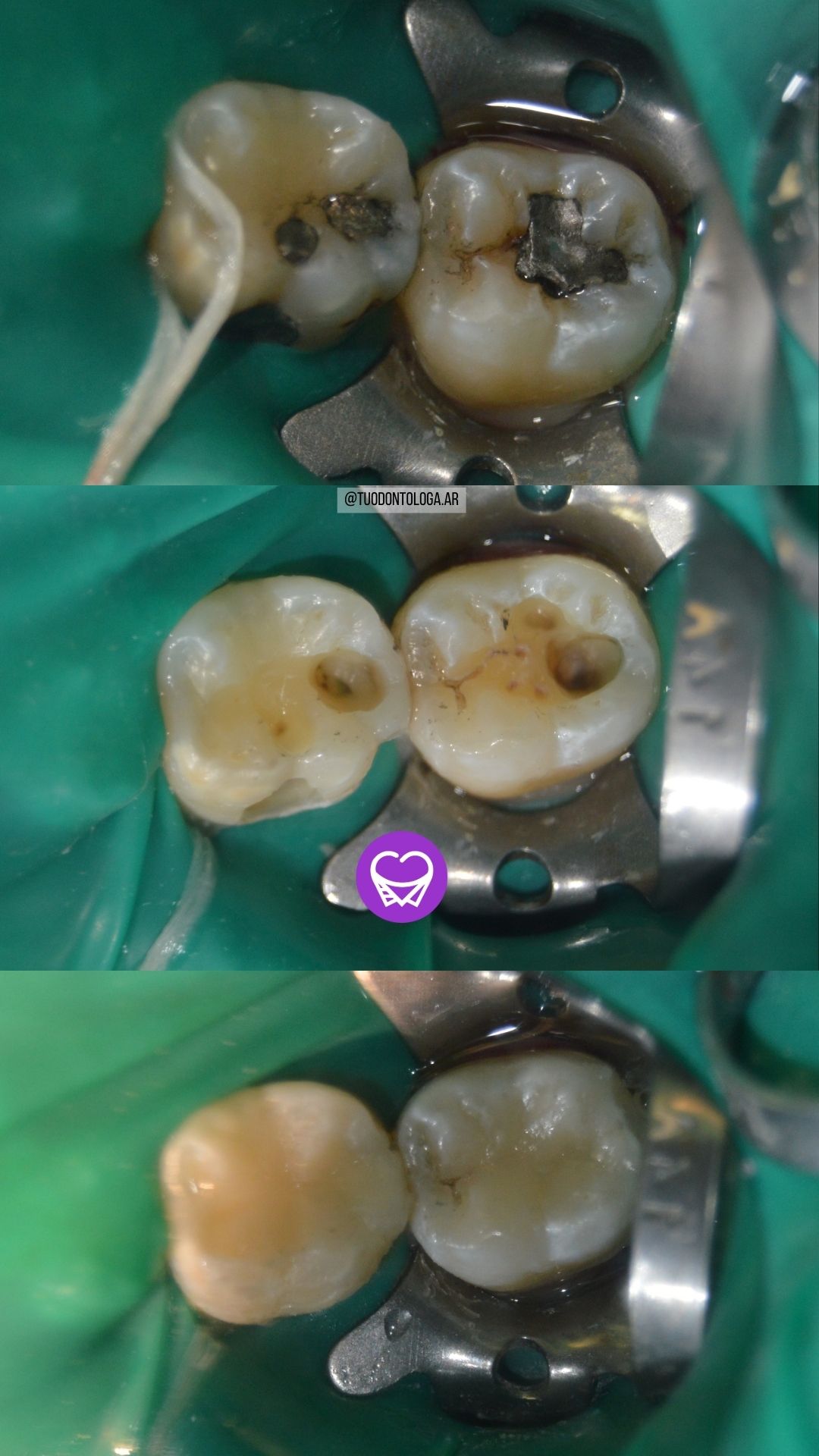 cambio de amalgamas defectuosas tuodontologa.ar