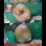 RESTAURACION DE COMPOSITE CON REFUERZO DE FIBRA  POSTERIOR A TRATAMIENTO DE CONDUCTO