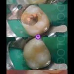 RESTAURACION DE COMPOSITE CON REFUERZO DE FIBRA POSTERIOR A TRATAMIENTO DE CONDUCTO