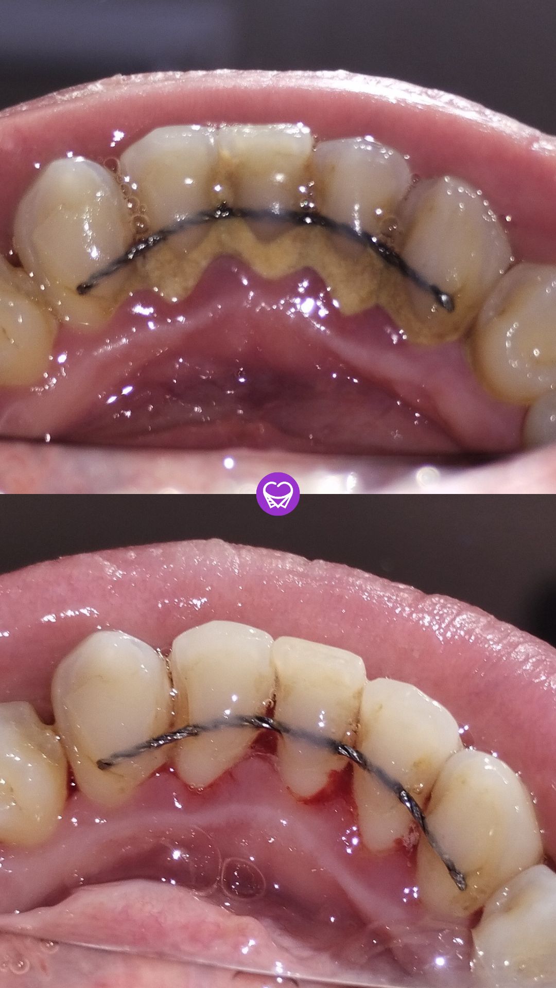 limpieza2 tuodontologa.ar