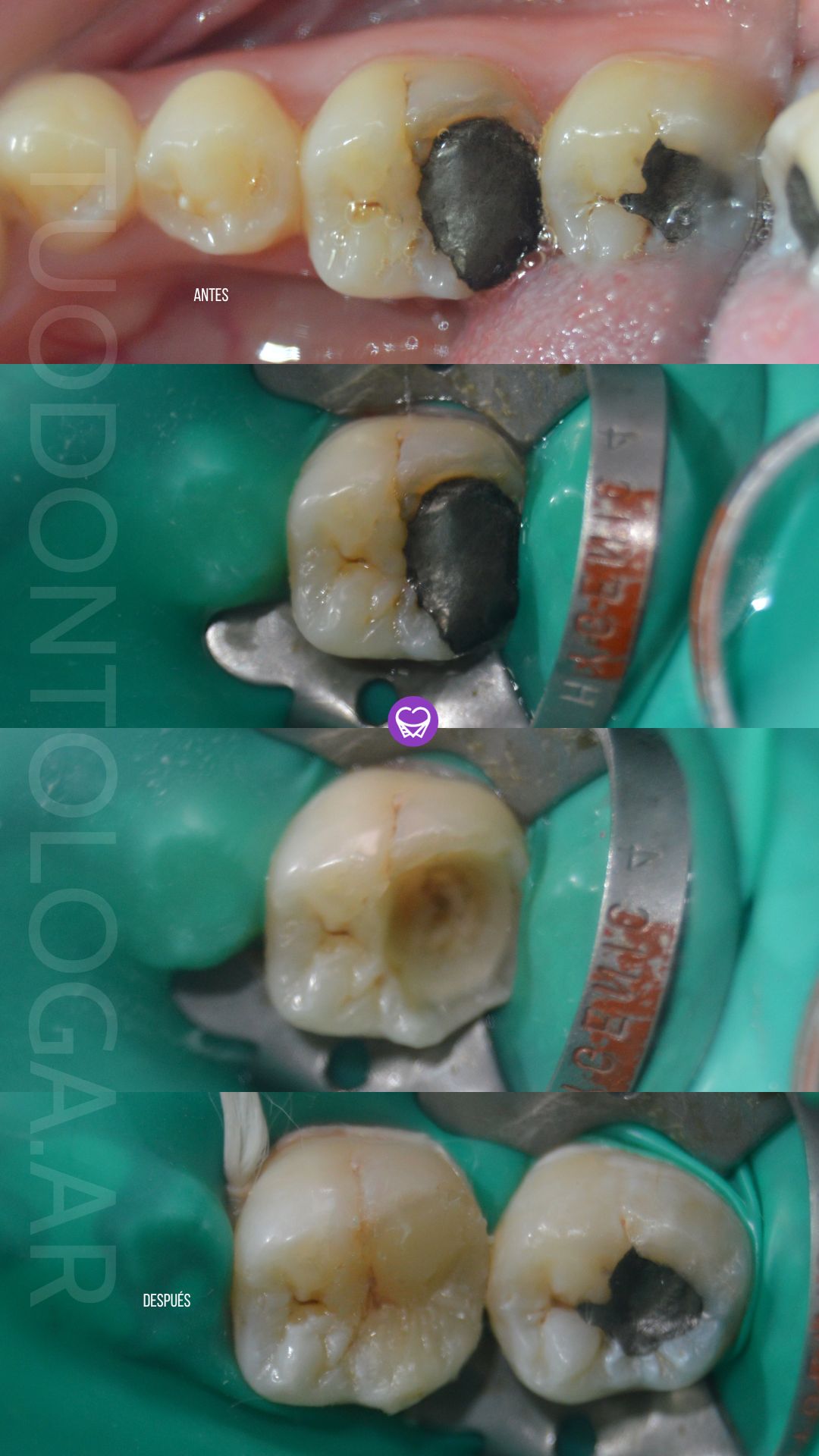 restauración defectuosa tuodontologa.ar