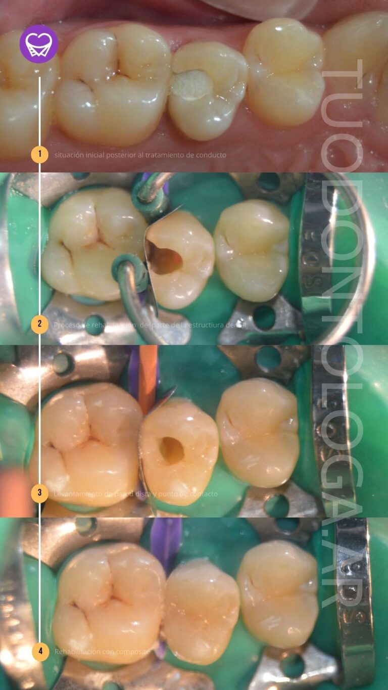 restauracion2 tuodontologa.ar