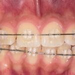 ORTODONCIA CON BRACKETS ESTETICOS