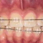 ORTODONCIA CON BRACKETS ESTETICOS