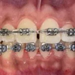 ORTODONCIA CON BRACKETS METALICOS CONVENCIONALES